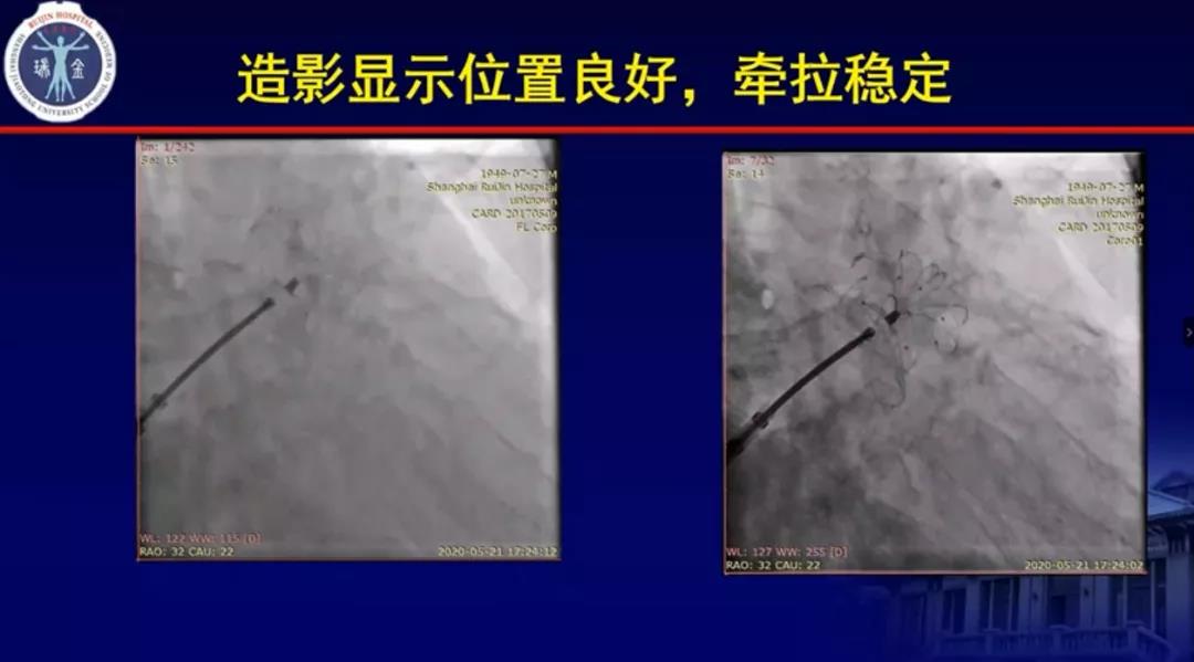 1122fl6462 1122fl6462